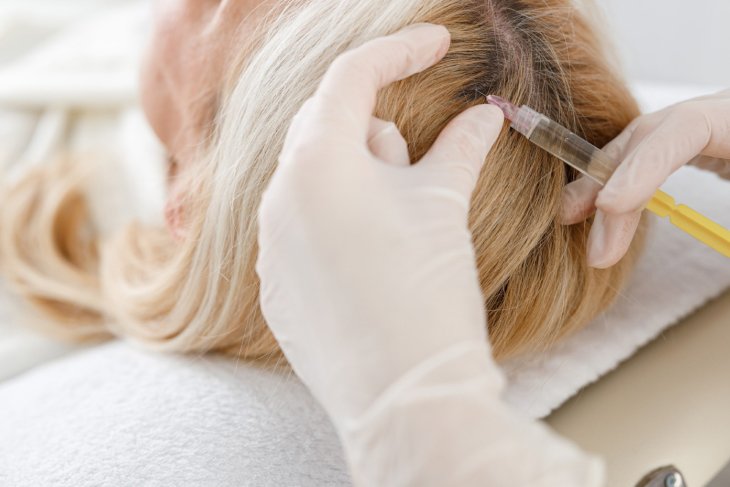 Hair Loss in Women